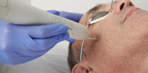 What is the PicoWay Laser? - Clean Canvas Laser Clinic