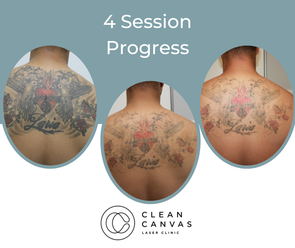 laser tattoo removal progress by Samarveera2008 | Laser tattoo removal, Tattoo  removal, Laser tattoo