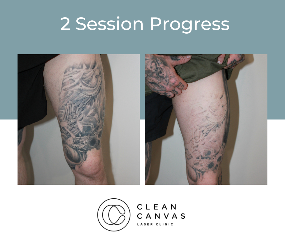 in progress These are this patient's results after 6 treatments! Let's get  rid of that unwanted ink. Whether you need complete removal... | Instagram