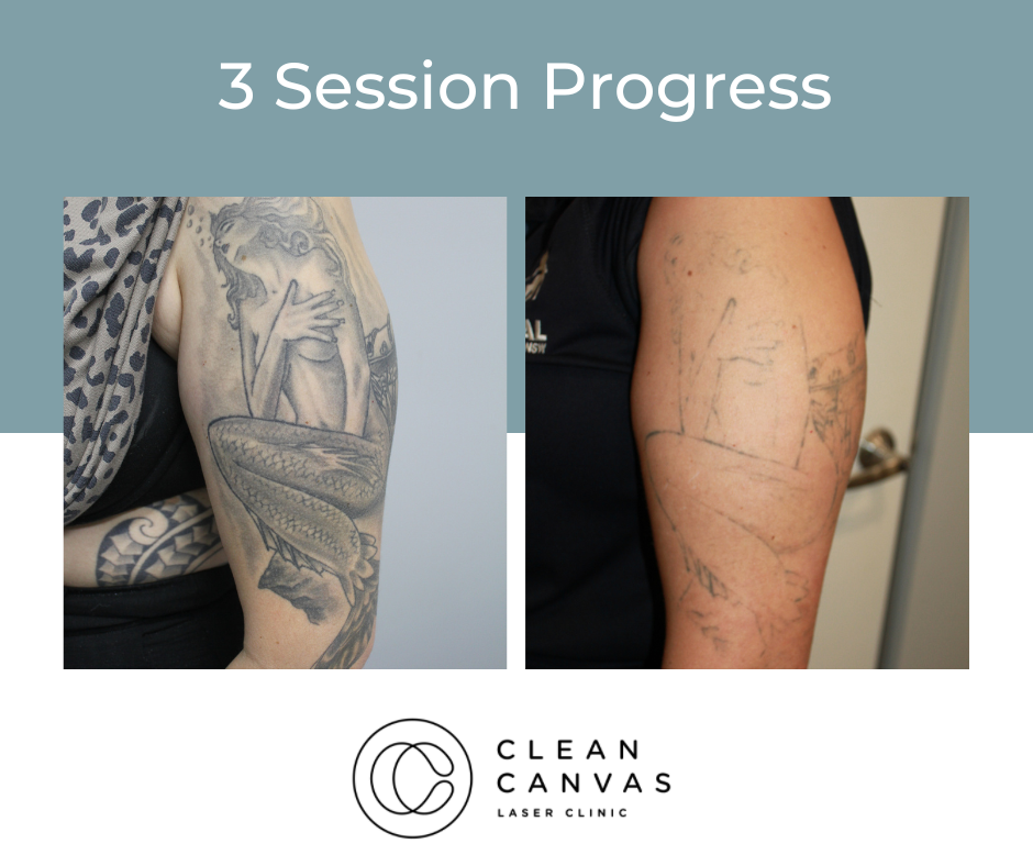 Tattoo Removal Session | Gosawa Beirut Deal